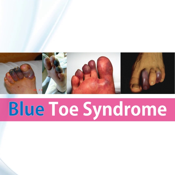 Blue Toe Syndrome featured rish academy